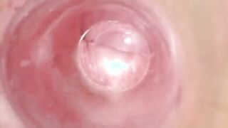 Having Fun with clear plug cervix watch