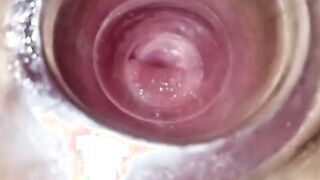 Having Fun with clear plug cervix watch