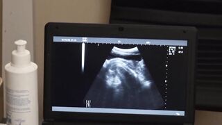 Flamed Youth Under the Surgeons Sizzling Anal Blade